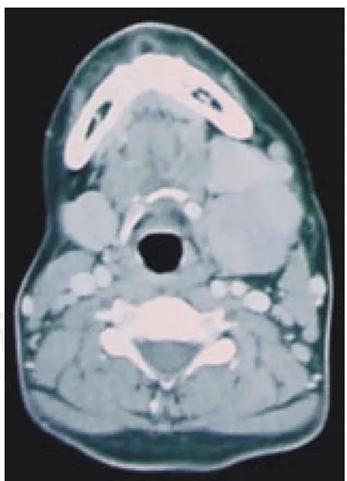 Figura 3. Tumor sólido isointenso no captante. Figura 4. Tumordesplazando glán-dula submaxilar.