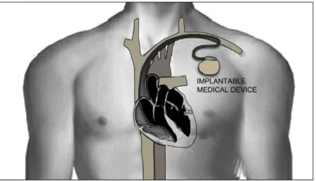 Fig. 2. Implantable medical device: pacemaker. 