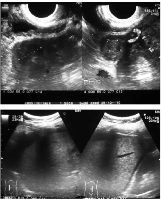Figura 4. USG transvaginal.