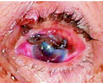 Cuadro 2. Distribución de la categorías del Ocular Trauma Score en ojos con y sin prolapso de tejido intraocular (n = 151).