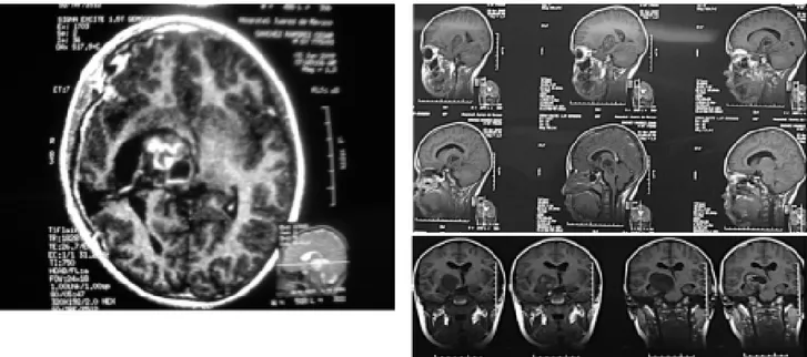 Figura 6. Ultrasonido transoperatorio en donde se aprecia un abanico en posición axial, demostrando en lo más superior en encéfalo, con un pequeño espacio hipoecogénico,  represen-tando plano de clivaje lateral al tumor y un tumor homogéneo en el centro de