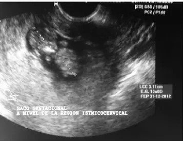 Figura 1. Ultrasonido pélvico que muestra fondo uterino va- va-cío, con eco endometrial lineal y saco gestacional a nivel de canal endocervical, con eco embrionario.