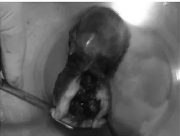 Figura 3. Pieza quirúrgica, correspondiente a útero sin anexos, con presencia de embarazo en canal endocervical, que dilata y aumenta de tamaño el cérvix.