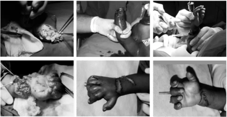 Figura 4. Secuencia de reimplante de mano en amputación a nivel de muñeca por avulsión-aplastamiento.