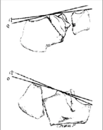 Figura 2. Ángulo articular de la tuberosidad.B