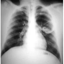 Figura 1.  Caso 1. Radiografía de tórax con signo de lirio acuático y neumonitis perilesional.