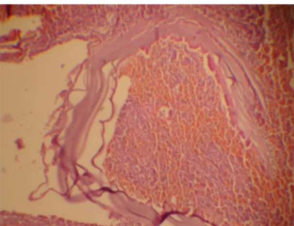 Figura 6.  Caso 1. Quiste con capa laminar anuclea- anuclea-da, externa y germinal interna.