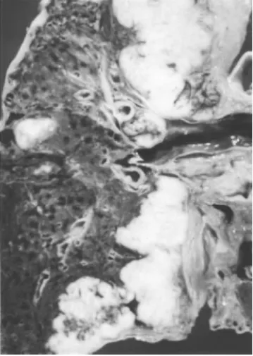 Figura 4. Acercamiento de la fotografía anterior, nótese la in- in-vasión pleural y las zonas de necrosis tumoral.
