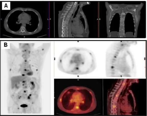 Figure 4. Patient with a NSCLC in the left superior lobe treated three years before with chemo- chemo-radiotherapy