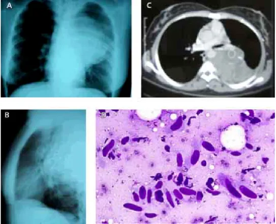 Figura 2. Mujer de 44 años con tumor mediastinal posterior izquierdo, que comprime vías