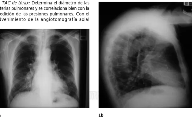 Figura 1. Radiografías posteroanterior y lateral del tórax.