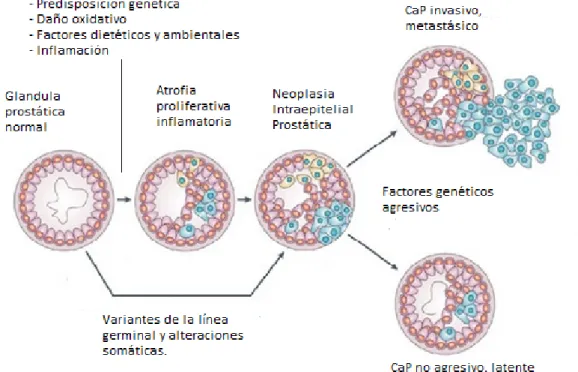 Figura 3. Modelo de progresión del cáncer de próstata. 