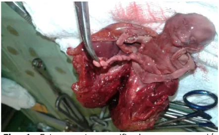 Fig.  1.  Feto  muerto  momificado  con  maceración  aséptica. 17 semanas. 