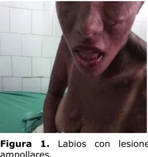 Figura 1. Labios con lesiones 