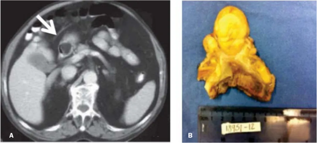 Figura 3. Metástasis a intestino delgado por un melanoma cutáneo.Figura 2. 