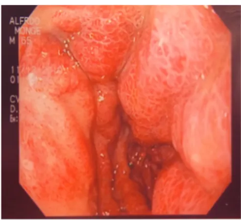 Fig 2. Ultrasonido de abdomen que  muestra dilatación de vía biliar intra  y extrahepática