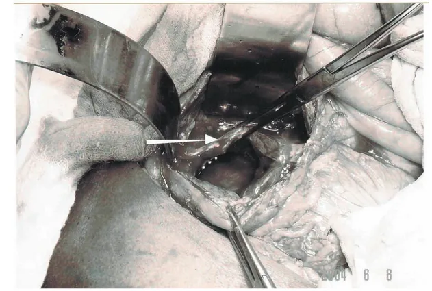 Figura 4. Biopsia transoperatoria a nivel de tabicación (flecha blanca) del seudoquiste.