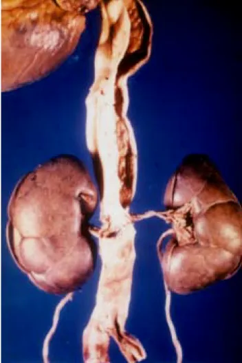 Figura 1. Caso 1. Aneurisma disecante de la aorta desde la raíz