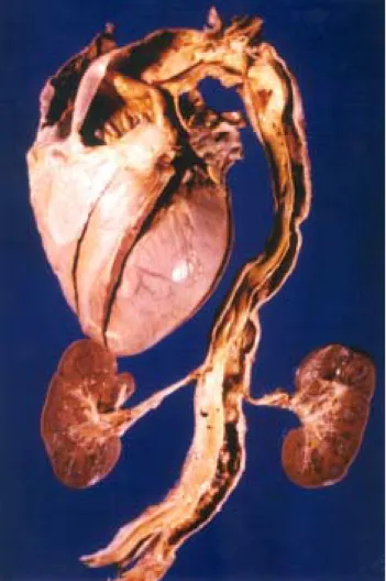 Figura 5. Caso 3. Aneurisma disecante de la aorta desde la raíz