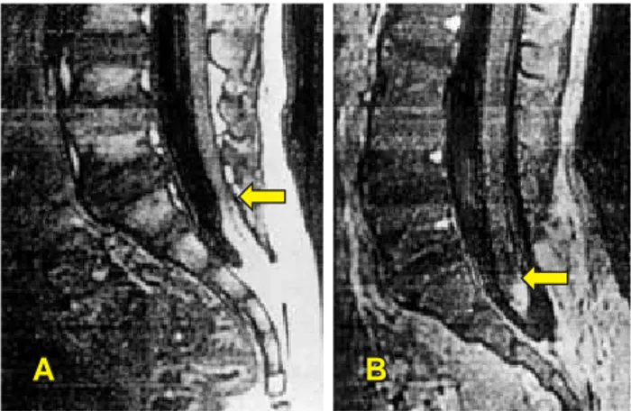 Figura 2. Resonancia magnética de un paciente con médula an-