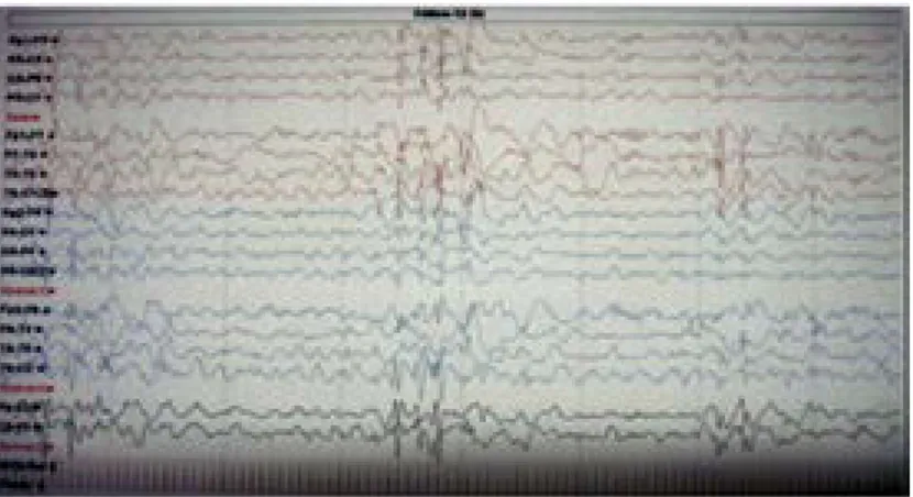 Figura 4  Electroencefalograma en sueño fisiológico que muestra polipuntas  generalizadas dentro ritmo de fondo lento (caso 1)