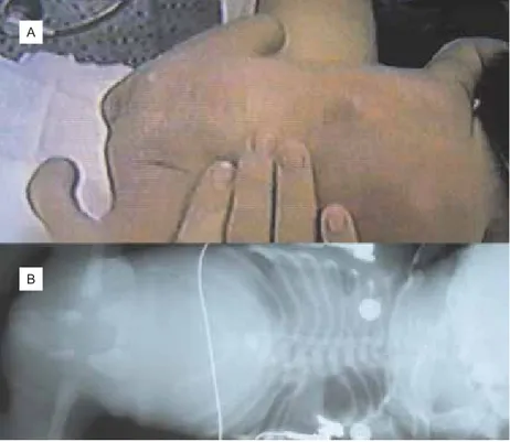 Figura 1 A) Protrusión lumbosacra co- co-rrespondiente a terminación de columna vertebral por  de-formidad toracolumbar