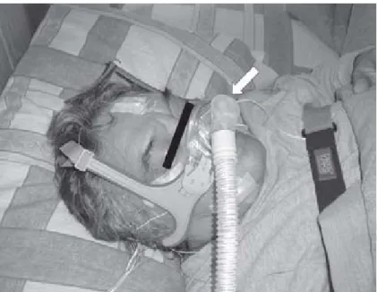 Figura 2. Utilización del sistema de presión positiva continua en la vía aérea (CPAP) en un paciente con síndrome severo de apnea obstructiva del sueño