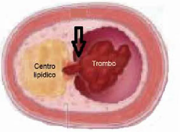 Figura 1  Ruptura de una placa coronaria vulnerable agudo de miocardio (1.92, 2.21 y 4.13 casos por 1000 personas-año en los países de ingresos altos, medios y bajos, respectivamente, p &lt; 0.001 para la tendencia).