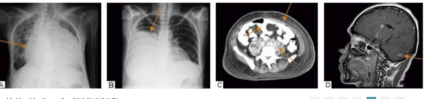 Figura 1  A. Derrame pericárdico masivo B. Derrame pleural derecho C. Engrosamiento del peritoneo parietal y visceral, ascitis 