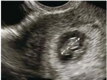 Figura 5 Medición de longitud cefalocaudal en un embarazo de 7.2 semanas de gestación