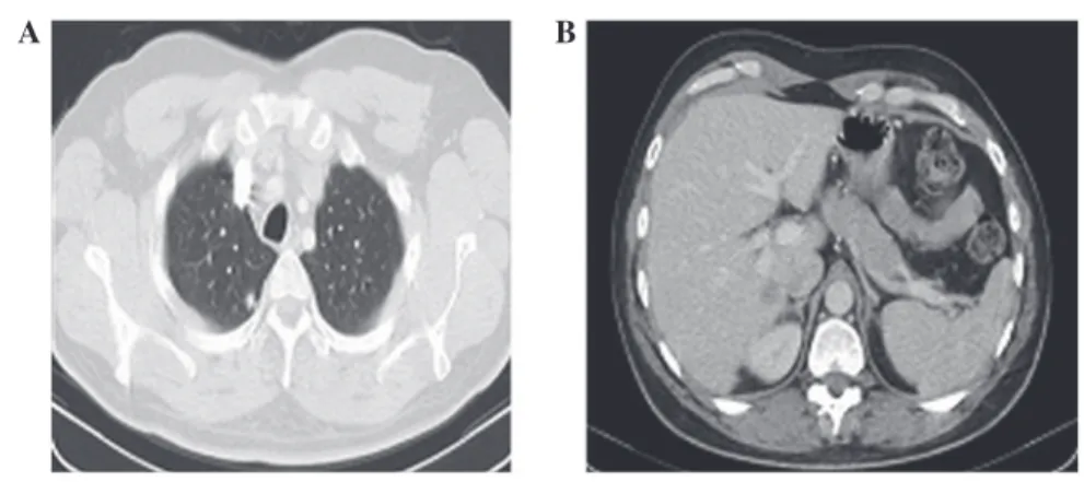 Table I. Characteristics of five patients included in the present study and their treatment response.