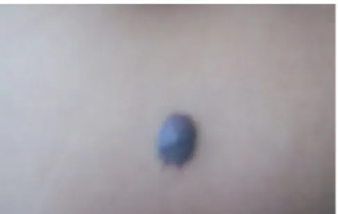 Fig. 2. Hemangiomas en el calcáneo.  