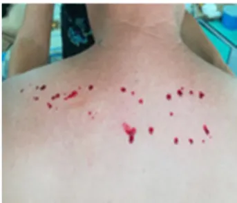 Fig. 2. Lesiones de capilaritis en tronco.