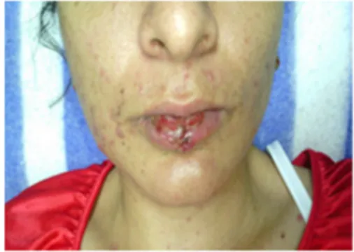 Fig. 1. Lesiones ulceradas en toda la cavidad bucal. 