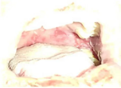 Fig. 3. Úlceras sangrantes y dolorosas, de bordes irregulares en toda la 
