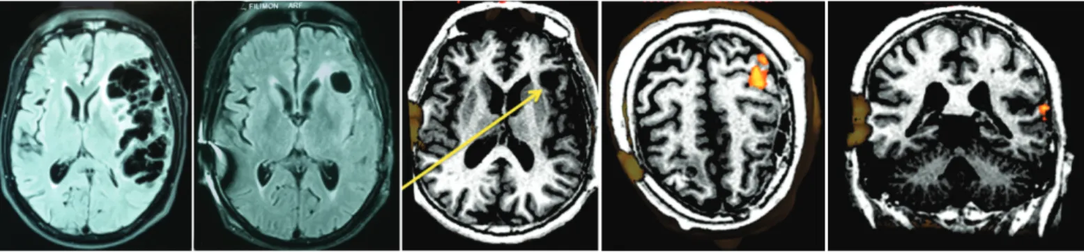 Figura 2. Neuronavegación con sonografía presentando las relaciones vasculares a nivel de la cisterna  de Silvio con ramas de la cerebral media en el efecto Doppler.