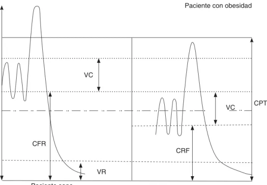 Cuadro II. Espirometría. Patrones funcionales.