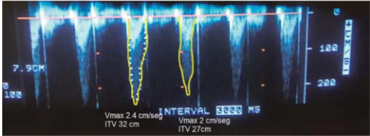 Figura 3. Área telediastólica.