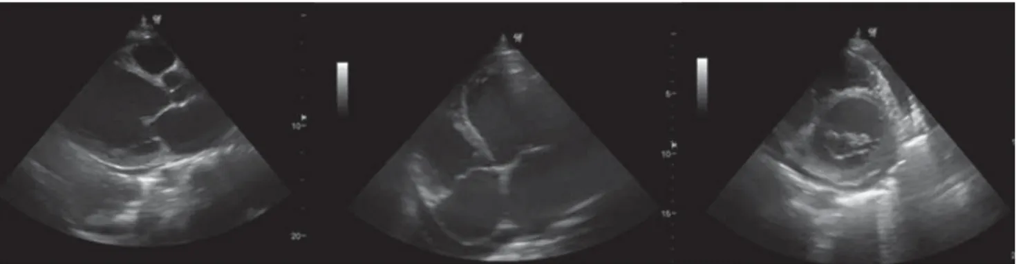 Figura 2. Ecocardiograma transtorácico. Se observa miocardiopatía dilatada con patrón restrictivo, ventrículo izquierdo dila-