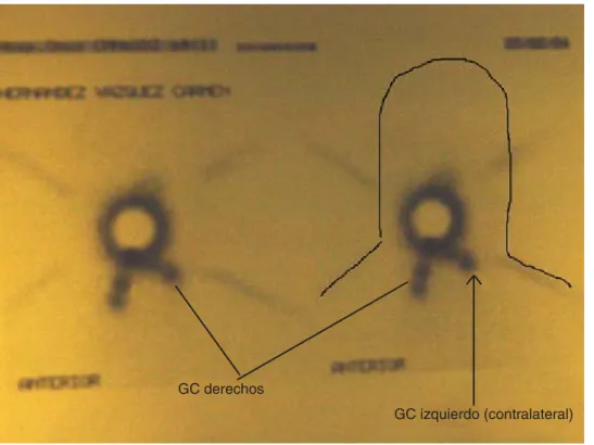 Figura 3. Linfogammagrafía
