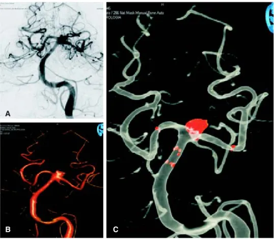 Figura 1. A: Angiografía con