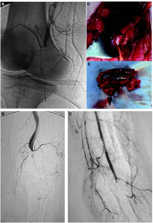 Figura 1.  A-C. Arteriografía