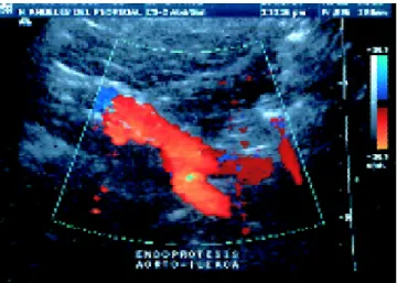 Figura 10.  Duplex color. Control postimplante de endopró- endopró-tesis aortoiliaca bilateral.