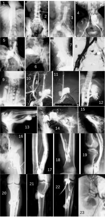 Figura 2. Fístulas arteriovenosas.