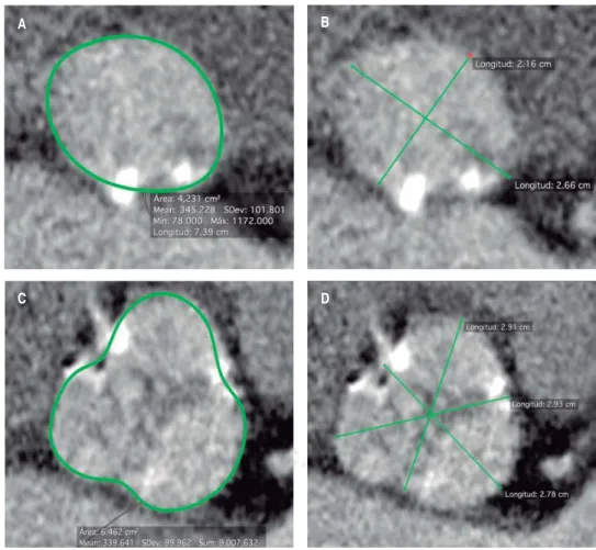 Figure 6.  Cardiac computed tomography (cardiac CT) with multiplanar reconstruction in axial plane showing the  aortic annulus diameters (A and B) and aortic cusps diameters (C and D)