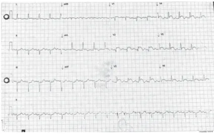 Figure 1:  Electrocardiogram showing ST-segment elevation in anterior leads with  T-wave inversion.