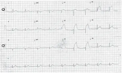 Figure 2:  Electrocardiogram showing ST-segment elevation in anterior leads with  positive T-wave.
