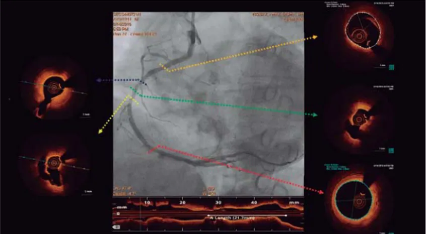 Figure 4. Coronary angiography in left anterior oblique projection at the time of delivery in the right coronary with an Absorb BVS 3.5 x 28 mm  (A), then an Absorb BVS 3.5 x 23 mm (B) and control angiography (C).