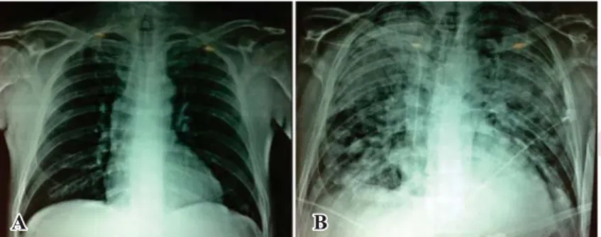 Figura 1. Teleradiografía de tórax del paciente a su ingreso (A) y cinco días des-