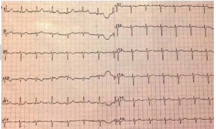 Figura 1. El electrocardiograma no mostró alteraciones signifi cati- cati-vas, excepto hemibloqueo fascicular anterior izquierdo.
